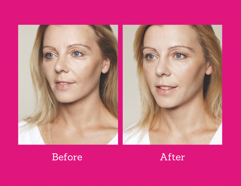 Galderma Hyaluronic skin booster treatment - Jeune Ascot Vale